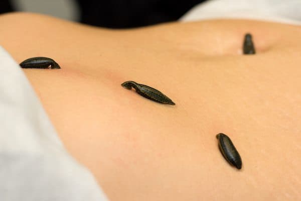 What is Leech Therapy?